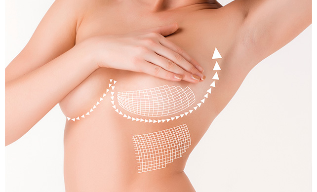 A Comprehensive Guide to Breast Lift Options in Scotland